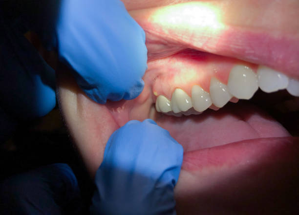 Best Emergency Dentist for Lost Fillings or Crowns in Santa Claus, IN